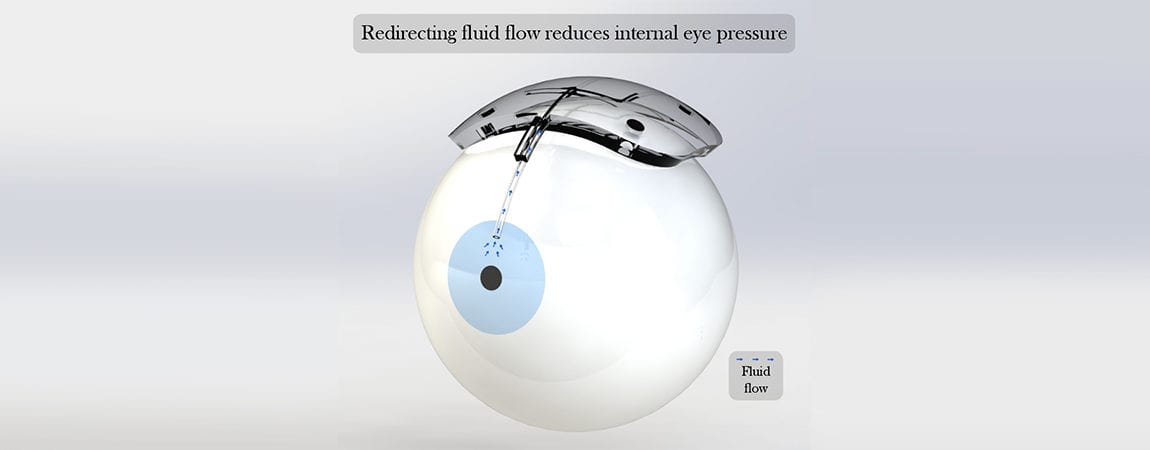 A Novel Implant for Regulating Excessive Eye Pressure in Glaucoma Patients